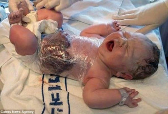 婴儿出生时内脏外露 医生包保鲜膜防感染