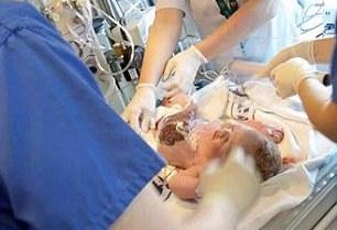 婴儿出生时内脏外露 医生包保鲜膜防感染
