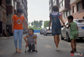 相依为命：袖珍男孩和烧伤女孩的爱情