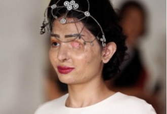 淋镪水毁容印度少女 纽约时装周担任模特儿