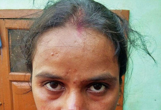 印度男子不满被拖欠5000元嫁妆 割掉妻子鼻尖