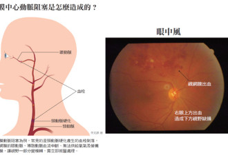 南京50岁女子贪玩手机刷朋友圈 右眼突然失明