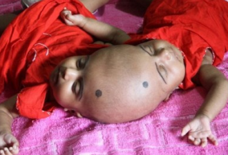 孟加拉妇诞连头婴 起初以为是孖女