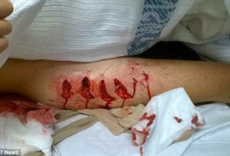 17岁男子遭大白鲨袭击后幸存 腿上留恐怖牙印