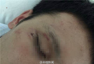 越南否认殴打中国公民 称“是他自己摔伤的”