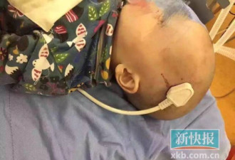 男童从床上跌下 三孔插头插入头颅触及脑部神经