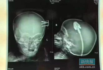 男童从床上跌下 三孔插头插入头颅触及脑部神经