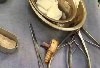 男童从床上跌下 三孔插头插入头颅触及脑部神经