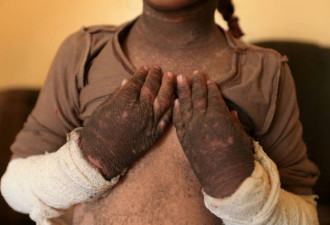 IS在伊拉克使用化学武器? 5岁女孩的手震惊世界
