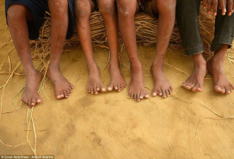 这个神秘家族 每个人都有12根手指 12根脚趾