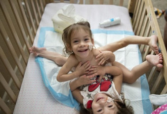连体双胞胎姐妹共用三条腿 术后一方或残疾