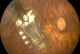 失明者的福音:眼睛修复芯片能训练大脑恢复视觉