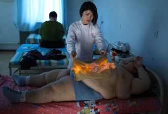 英媒关注中国11岁小胖娃火疗拔罐减肥