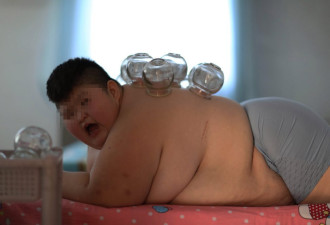 英媒关注中国11岁小胖娃火疗拔罐减肥