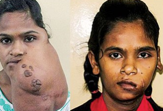 移除脸上肿瘤 印度16岁少女重获新生