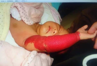 刚出生10天的宝宝，一只手臂全变成了红色