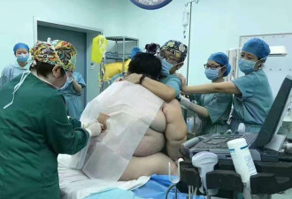 湖南280斤孕妇生产 16名医务人员出动