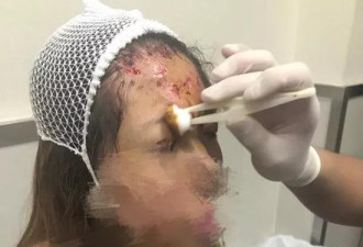 滴滴又出事 25岁女模特在北京坐快车惨被毁容