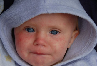 麻疹正肆虐欧洲 但远比病毒更可怕的是