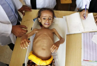 也门女童饿成皮包骨 千万人面临饥饿威胁