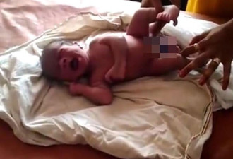 震惊！印度一男婴长有四条腿两套生殖器