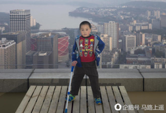 2年前病床上跳小苹果的男孩长大了 双腿截肢
