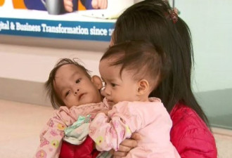 亚裔连体双胞胎今日抵澳，耗资$30万做手术