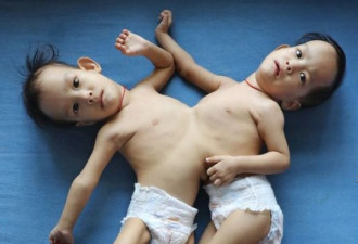 亚裔连体双胞胎今日抵澳，耗资$30万做手术