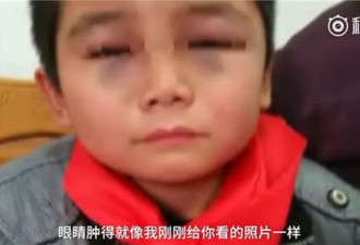 安徽老师把小学生打成熊猫眼 教育局：立即调查