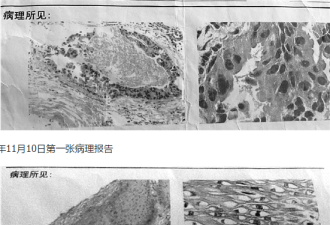 女子两次放疗后被告知没患癌 医院:医生看错了