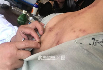 杭州名中医养几万只蜜蜂 病人每天排队等着被蜇