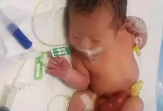 揪心！刚出生女婴被弃医院 消化器官露在肚子外