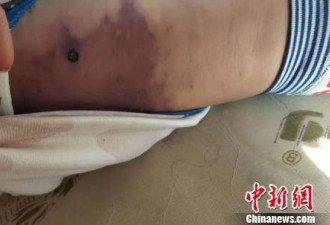 3岁童感染“食肉菌” 后背几乎被细菌“吃掉”