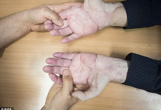 英国首例双手移植患者可以自己用手开门