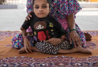 印度少女患脆骨症 18年已骨折千余次