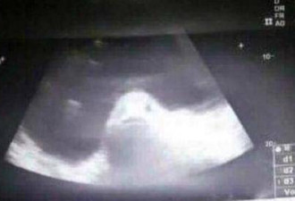 菲律宾少女被疑未婚先孕 肚子扫描现条“鱼”