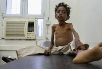 他的2岁表弟饿死 世界面临最大人道危机