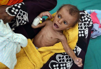 也门战争打了4年8.5万儿童饿死:连哭都没力气！