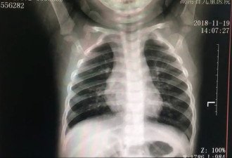 湘潭1岁男童误吸痱子粉 患上吸入性肺炎