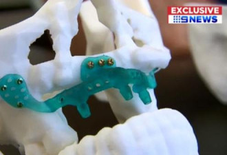 澳女患癌后几乎毁容 靠3D打印骨头重获新生