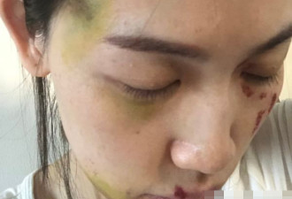 网晒马蓉“被打”伤势照片 大面积淤青不忍直视