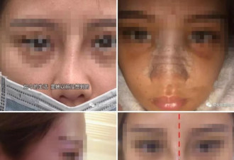 网络女主播隆鼻却整歪了！医院：我还没营业...