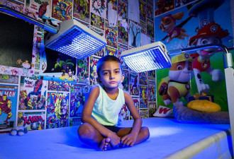 英国4岁男童患怪病 每天需蓝光照射20小时
