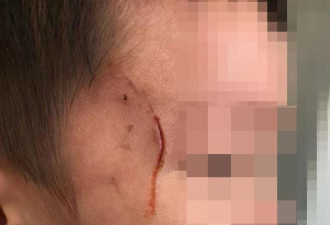 3岁男童被老师手镯划伤脸 家长索赔15万并报警