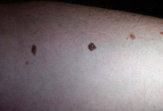 近7成澳人不做皮肤癌年检 连早期迹象也不清楚