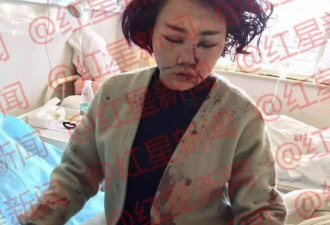 136天后丽江被打毁容女孩首次公开近照和遗书