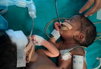 连体女婴手术后成功分离！ 印度众医生自拍庆祝