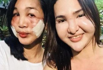 为了变美姐妹一起整容 结果却双双变成了丑八怪