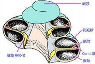人工耳蜗为何值 20 万？丢失后需重新开颅植入?