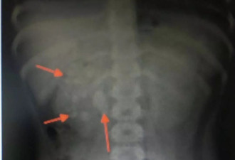 9岁娃肾里取出56颗结石 原来他只吃这些东西